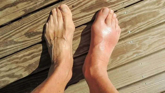 uric acid symptoms in hindi 